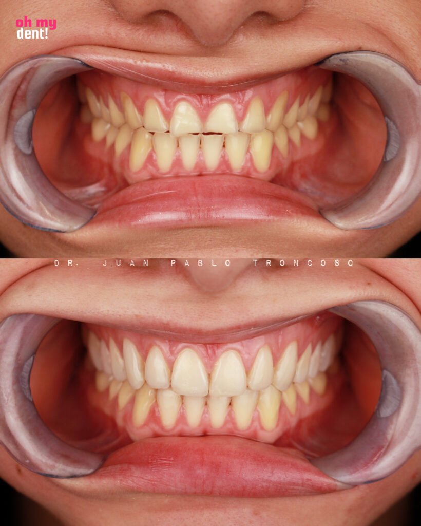 Caso Clínico de transformación de Dr Juan Pablo Troncoso Geraldo Viña del Mar, Chile - mejores dentistas.