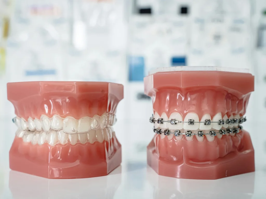 comparatva entre brackets e invisaling en mejores dentistas