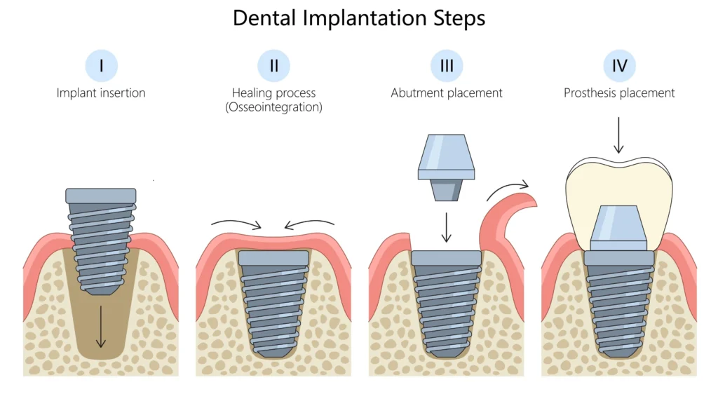 pasos de la instalación de un implante dental, desde la cirugia de implantes ahasta la rehabilitación con la corona definitiva - mejores dentistas Chile